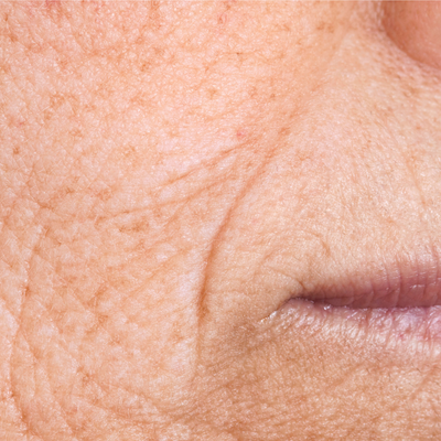 SKIN AGING & WRINKLES